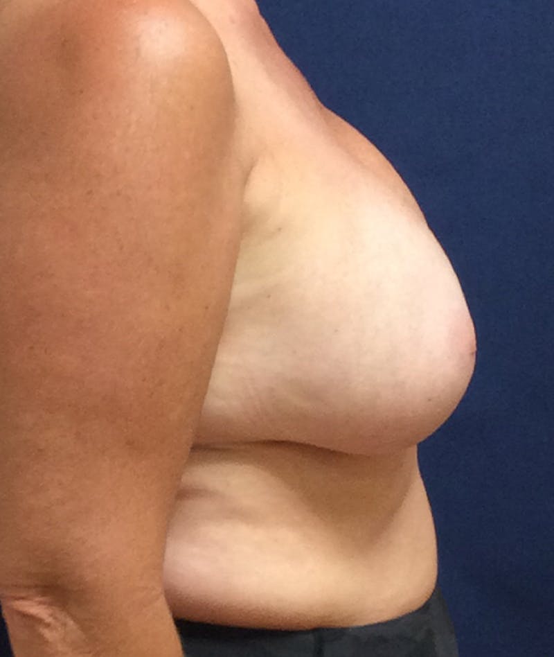 Breast Lift Before & After Gallery - Patient 293049 - Image 5