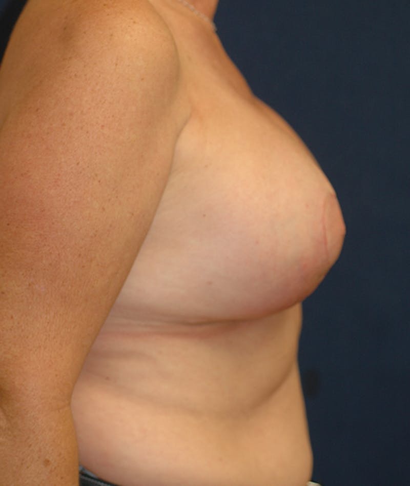Breast Lift Before & After Gallery - Patient 293049 - Image 6