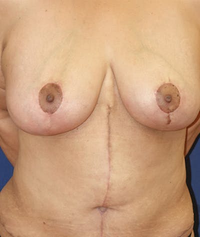 Breast Lift Before & After Gallery - Patient 262591 - Image 2