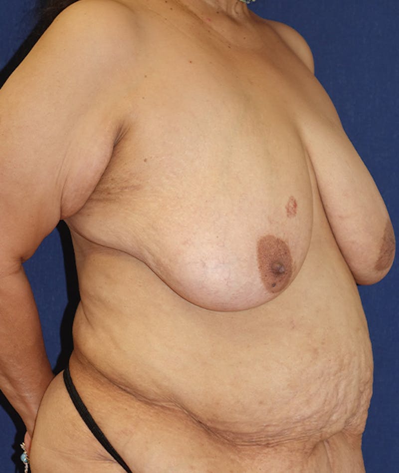 Breast Lift Before & After Gallery - Patient 262591 - Image 5