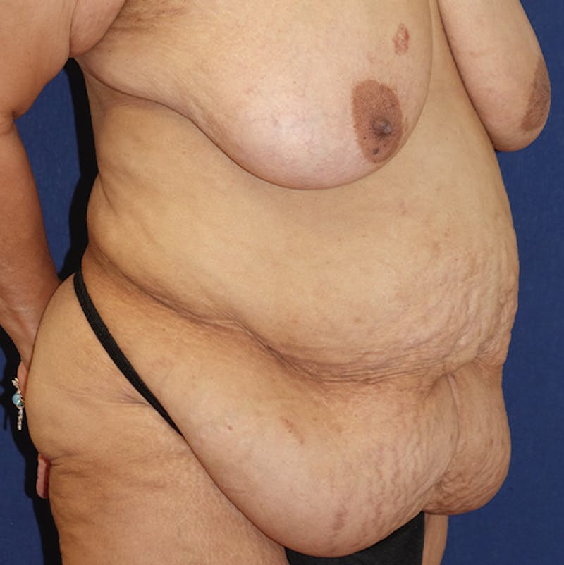 Tummy Tuck (Abdominoplasty) Before & After Gallery - Patient 190675 - Image 5