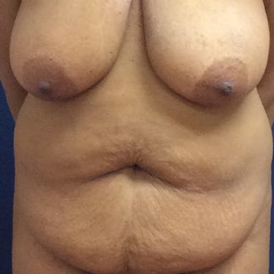 Liposuction Before & After Gallery - Patient 587239 - Image 1