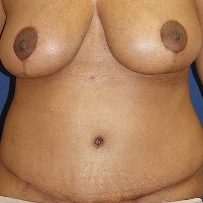 Liposuction Before & After Gallery - Patient 587239 - Image 2