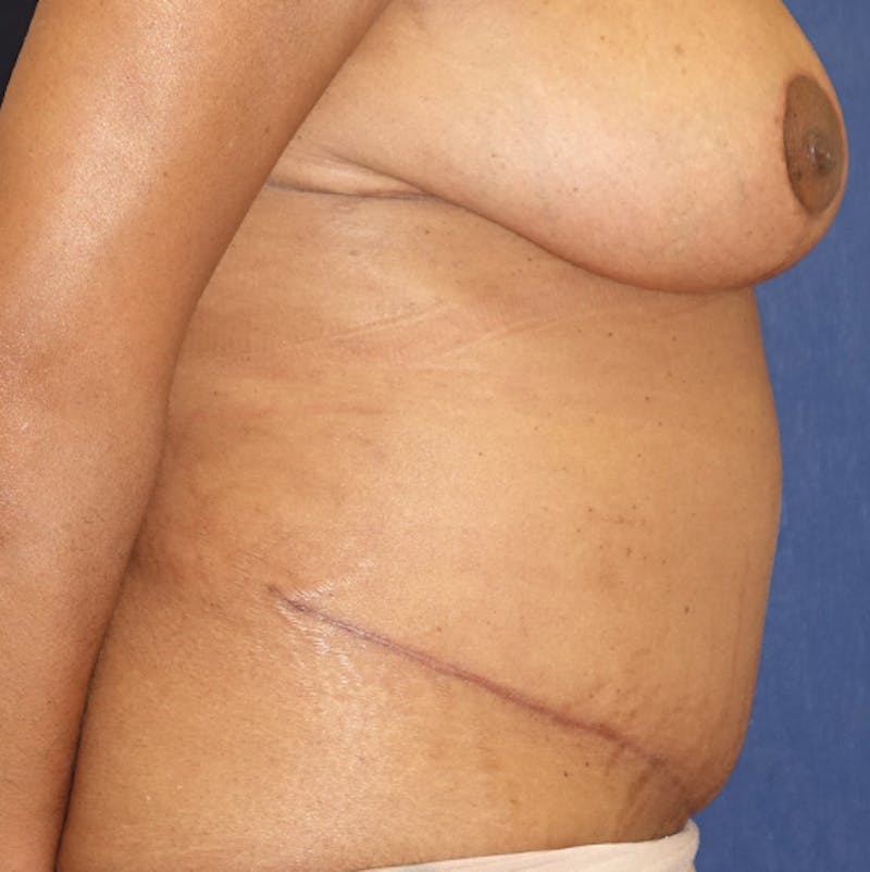 Liposuction Before & After Gallery - Patient 587239 - Image 6