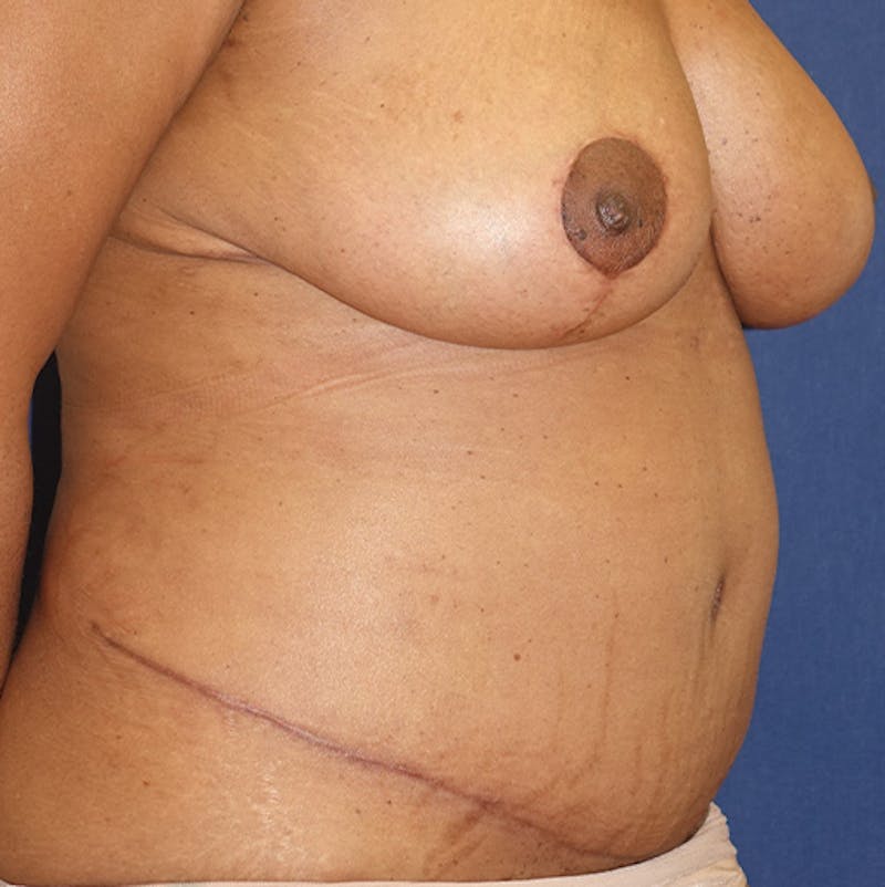 Liposuction Before & After Gallery - Patient 587239 - Image 4
