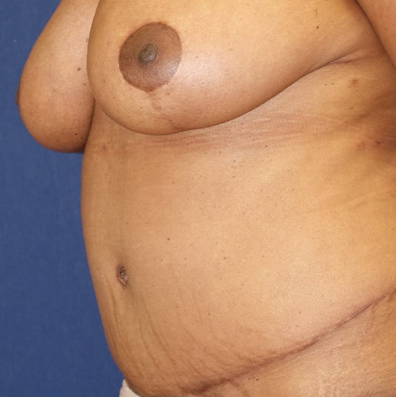 Liposuction Before & After Gallery - Patient 587239 - Image 8