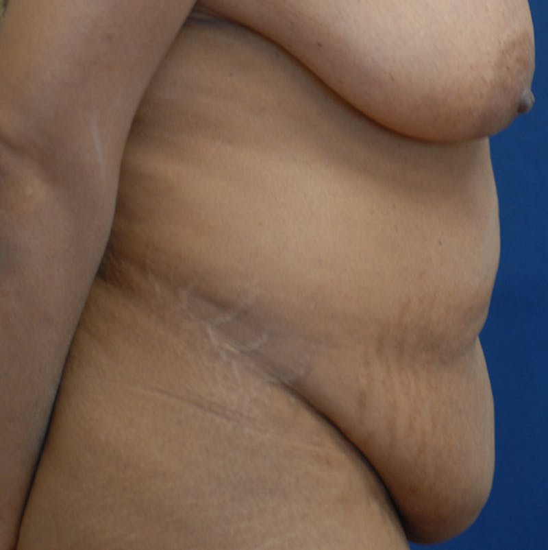 Liposuction Before & After Gallery - Patient 587239 - Image 5