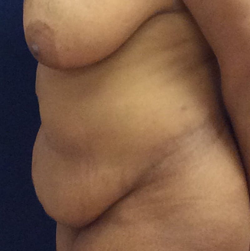 Liposuction Before & After Gallery - Patient 587239 - Image 9