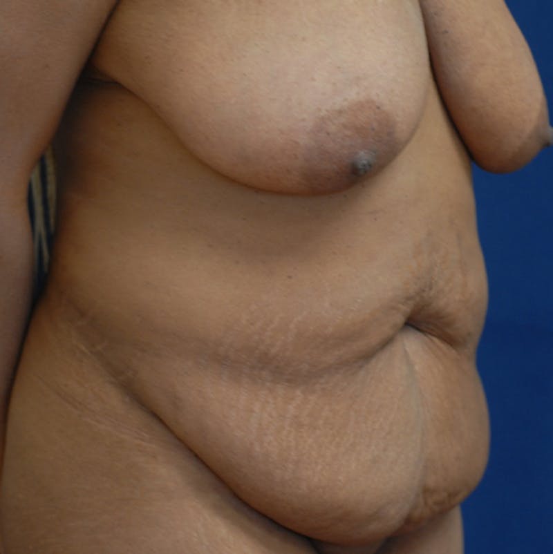 Liposuction Before & After Gallery - Patient 587239 - Image 3