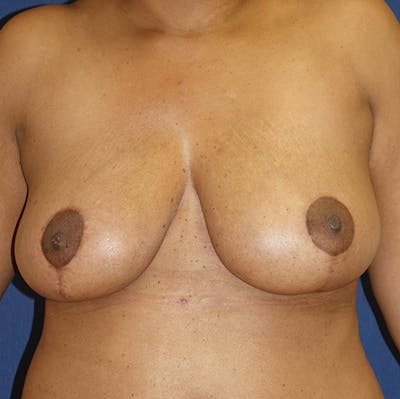 Breast Reduction Before & After Gallery - Patient 273260 - Image 2