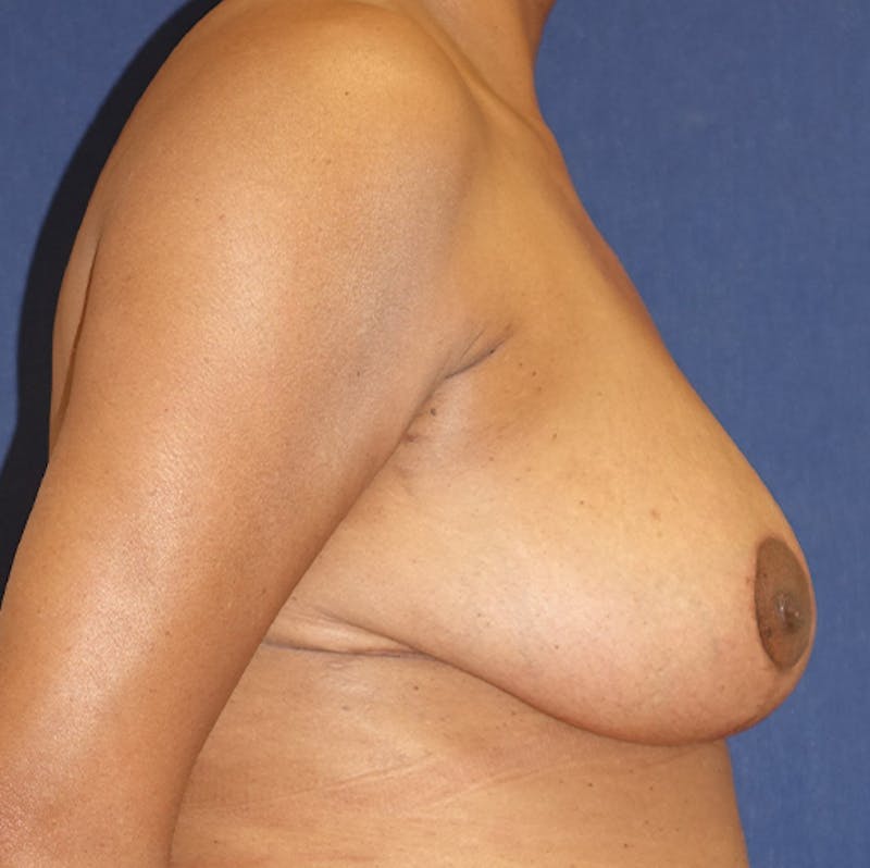 Breast Reduction Before & After Gallery - Patient 273260 - Image 10