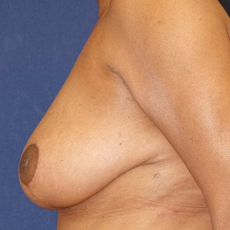 Breast Reduction Before & After Gallery - Patient 273260 - Image 4