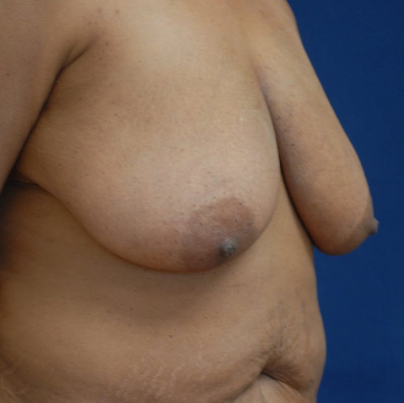 Breast Reduction Before & After Gallery - Patient 273260 - Image 7