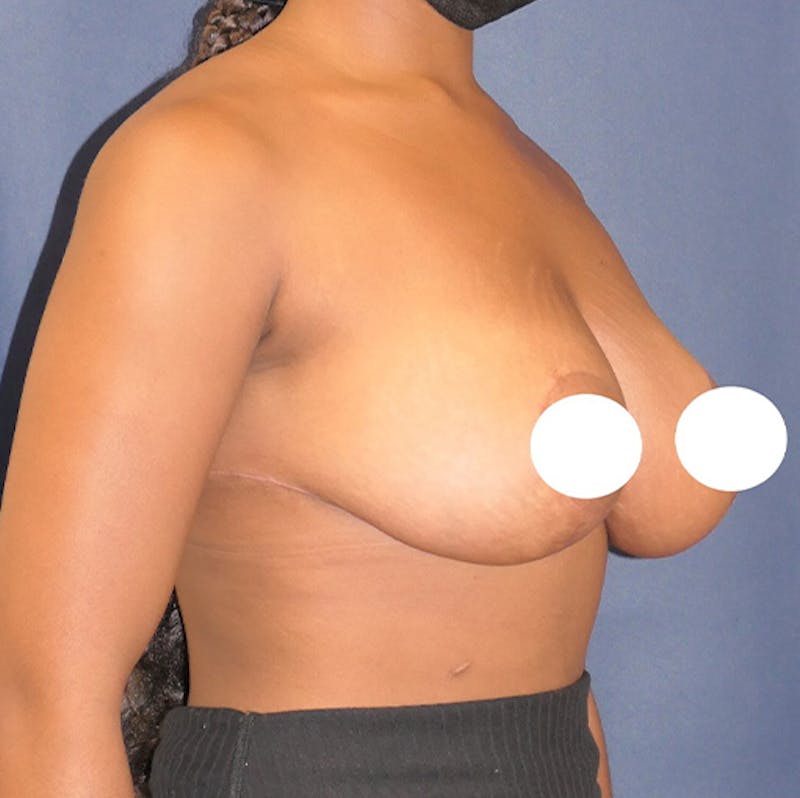 Breast Reduction Before & After Gallery - Patient 237812 - Image 10