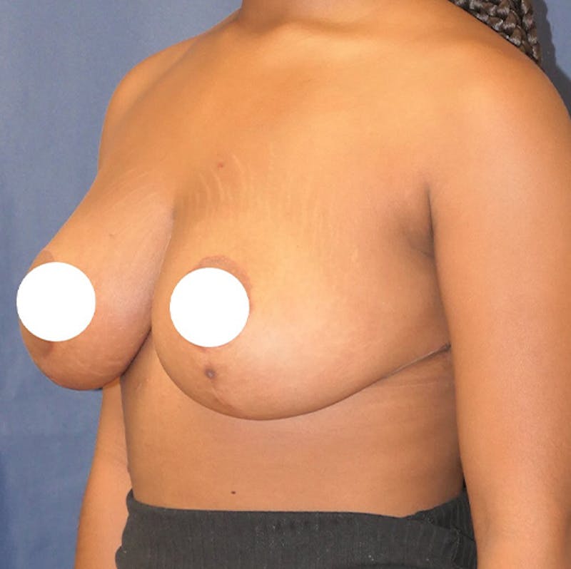 Breast Reduction Before & After Gallery - Patient 237812 - Image 6