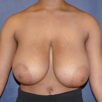 Breast Reduction Before & After Gallery - Patient 237812 - Image 1
