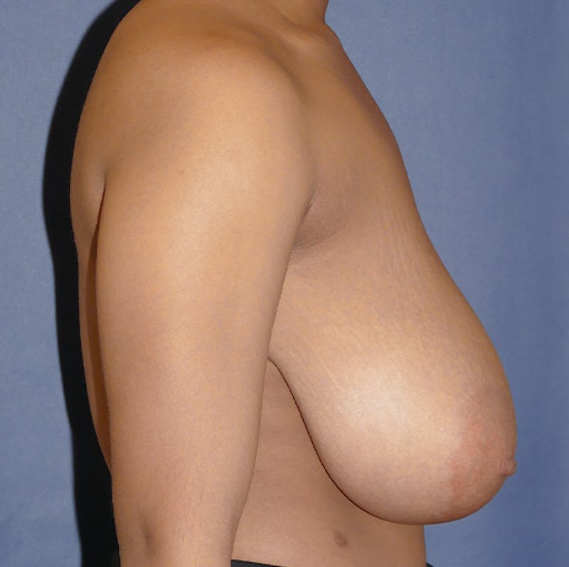 Breast Reduction Before & After Gallery - Patient 237812 - Image 7