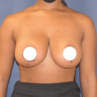 Breast Reduction Before & After Gallery - Patient 237812 - Image 2