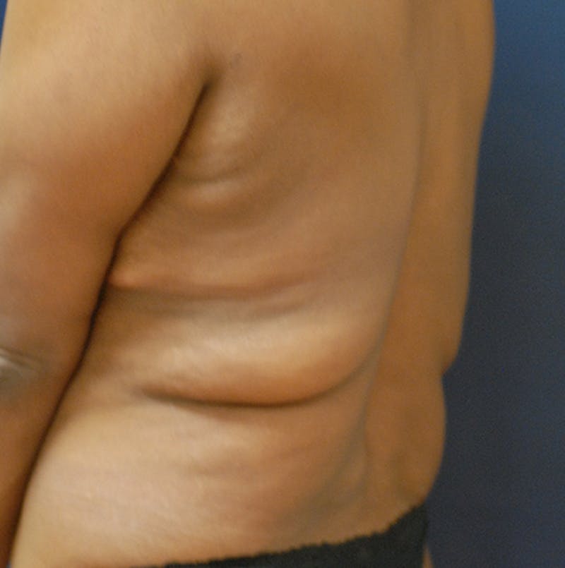 Back Lift Before & After Gallery - Patient 363579 - Image 5