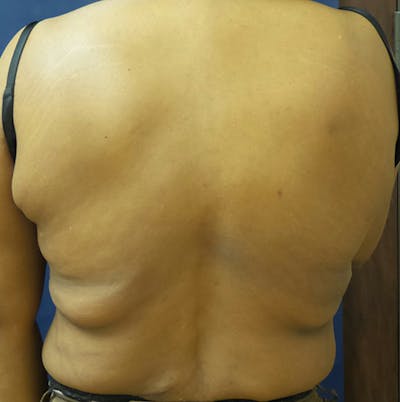 Back Lift Before & After Gallery - Patient 363579 - Image 1