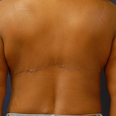 Back Lift Before & After Gallery - Patient 363579 - Image 2