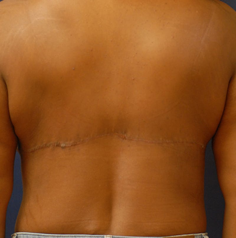 Back Lift Before & After Gallery - Patient 363579 - Image 2