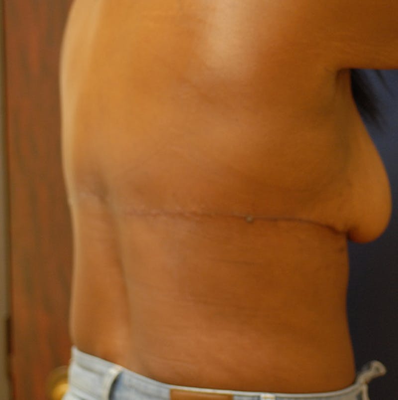 Back Lift Before & After Gallery - Patient 363579 - Image 4