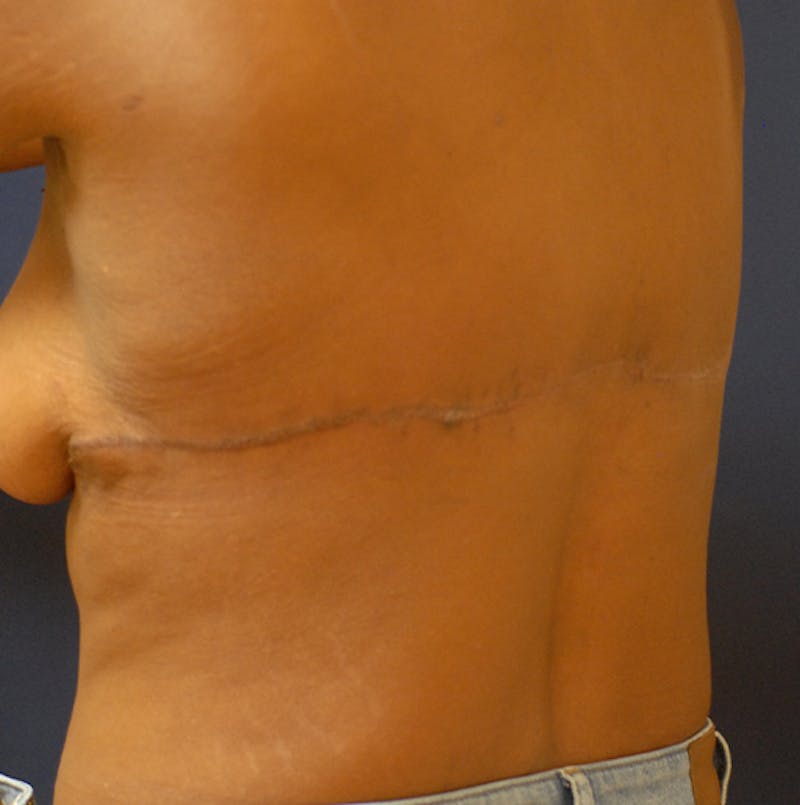 Back Lift Before & After Gallery - Patient 363579 - Image 6