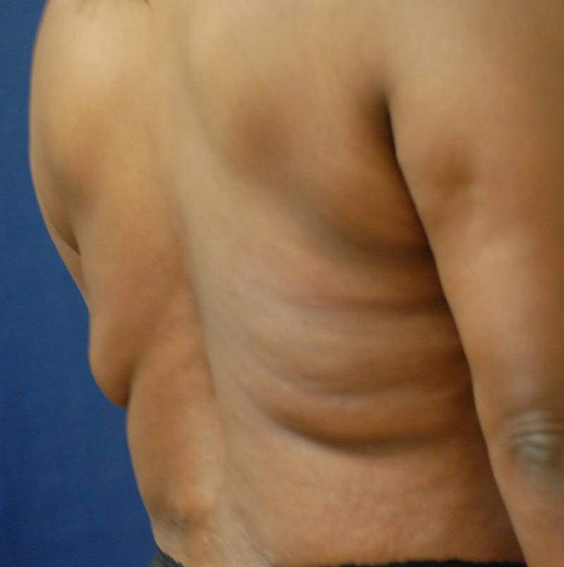 Back Lift Before & After Gallery - Patient 363579 - Image 3