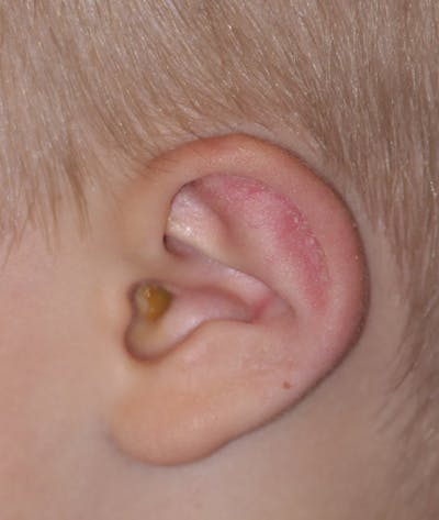 Otoplasty Before & After Gallery - Patient 639841 - Image 2