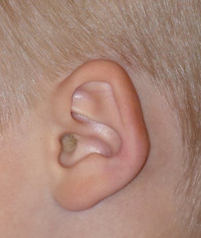 Otoplasty Before & After Gallery - Patient 639841 - Image 1