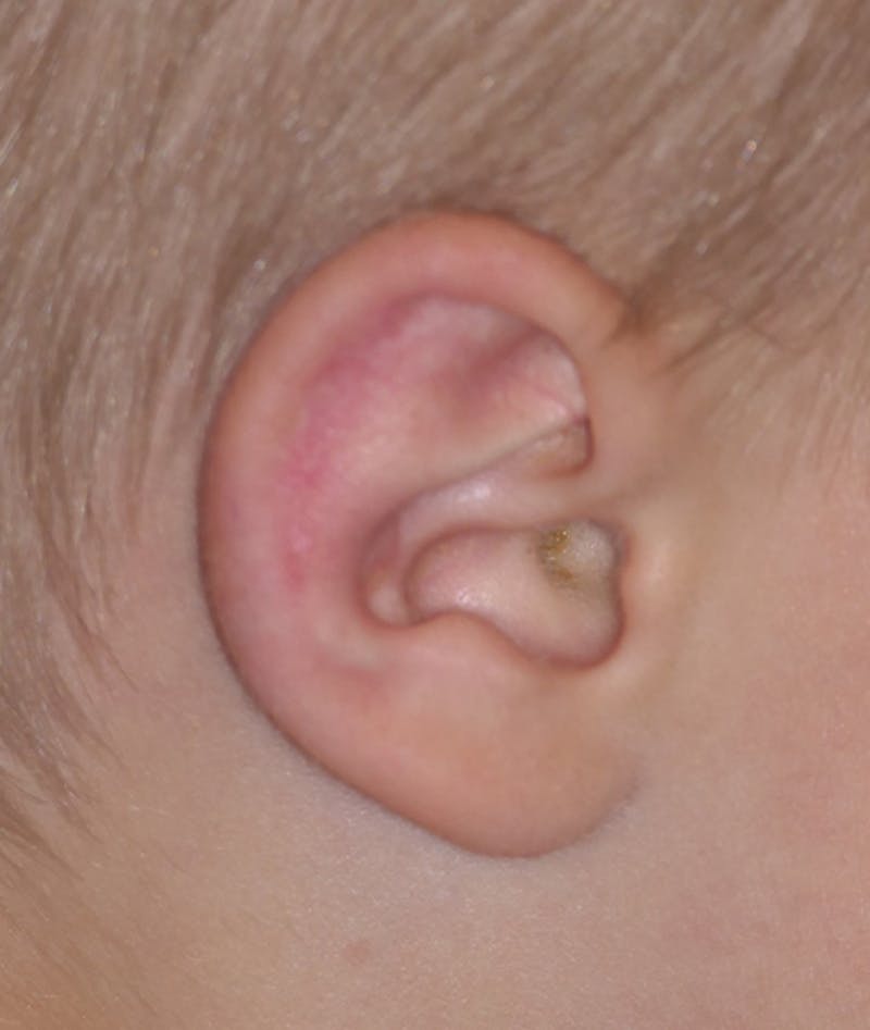 Otoplasty Before & After Gallery - Patient 639841 - Image 4