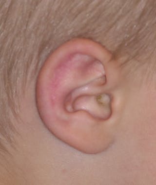 Otoplasty Before & After Gallery - Patient 639841 - Image 4