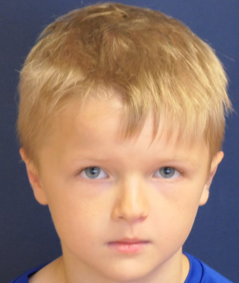 Otoplasty Before & After Gallery - Patient 639841 - Image 8