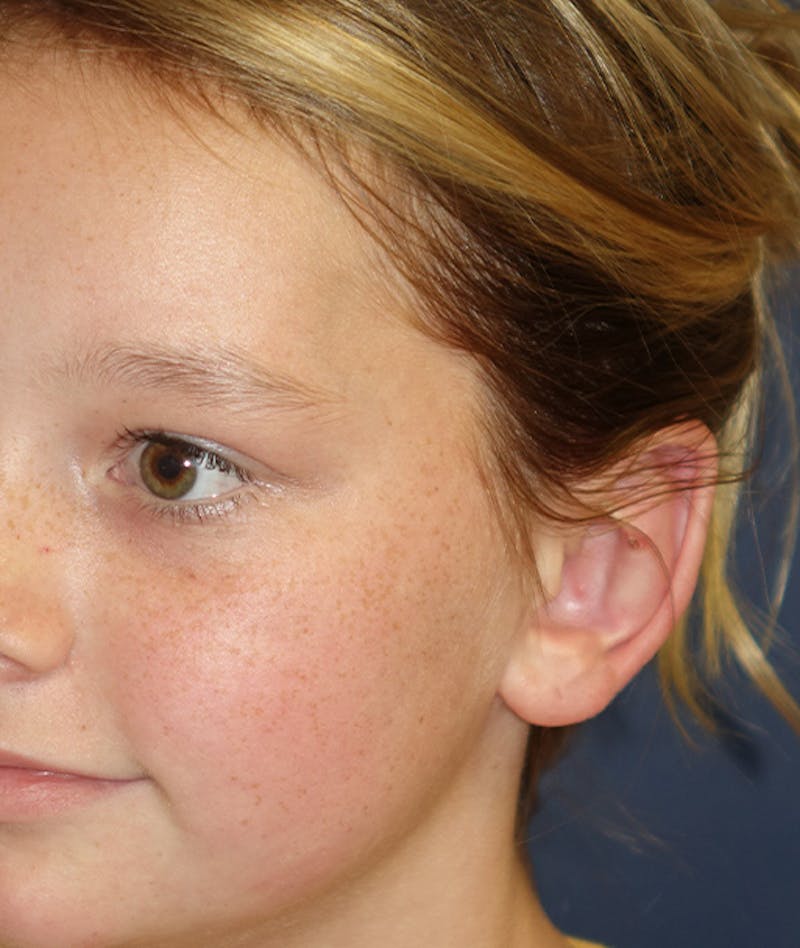 Otoplasty Before & After Gallery - Patient 262732 - Image 10