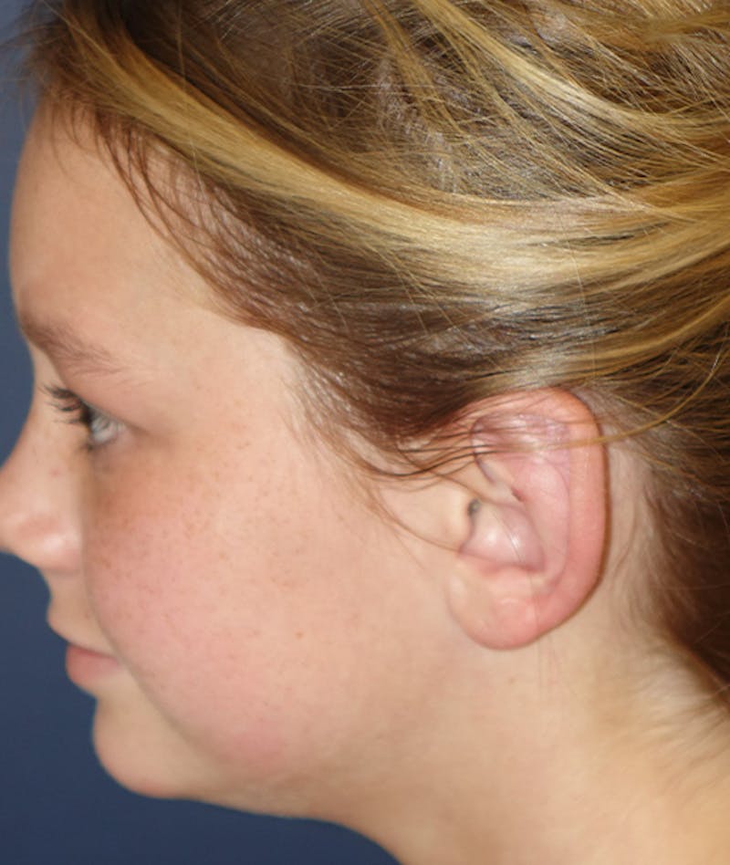 Otoplasty Before & After Gallery - Patient 262732 - Image 8