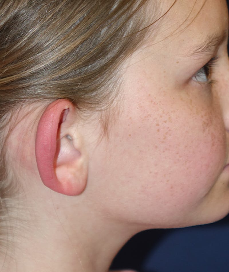 Otoplasty Before & After Gallery - Patient 262732 - Image 5