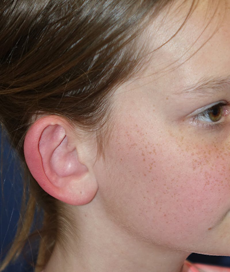 Otoplasty Before & After Gallery - Patient 262732 - Image 3