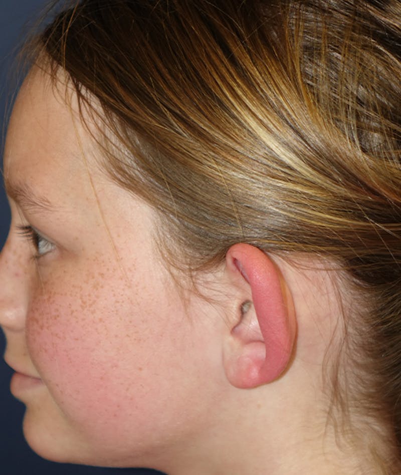 Otoplasty Before & After Gallery - Patient 262732 - Image 7