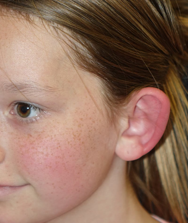 Otoplasty Before & After Gallery - Patient 262732 - Image 9