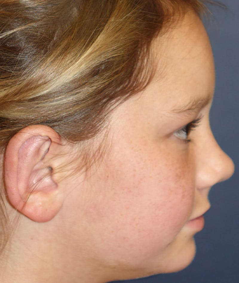 Otoplasty Before & After Gallery - Patient 262732 - Image 6