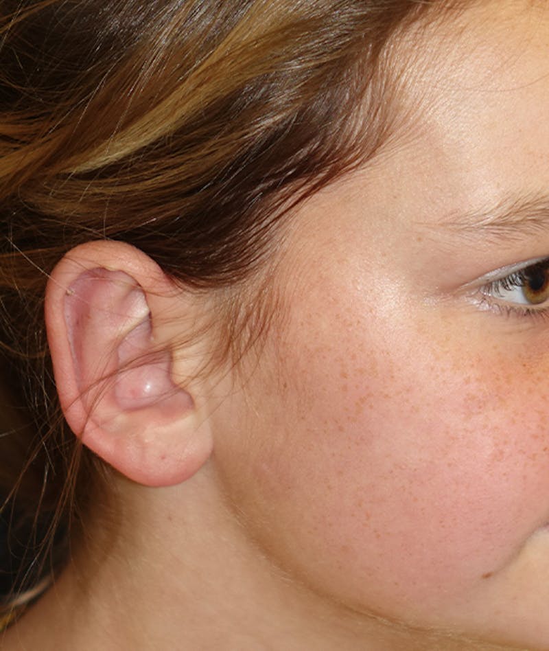 Otoplasty Before & After Gallery - Patient 262732 - Image 4