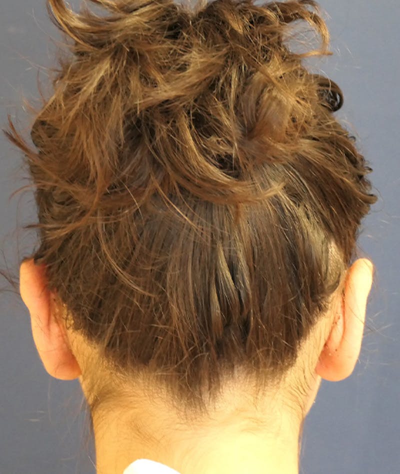 Otoplasty Before & After Gallery - Patient 423983 - Image 8