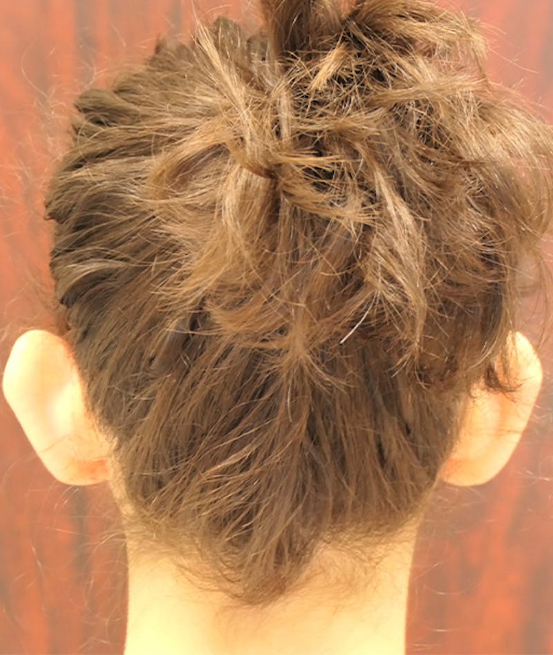 Otoplasty Before & After Gallery - Patient 423983 - Image 7