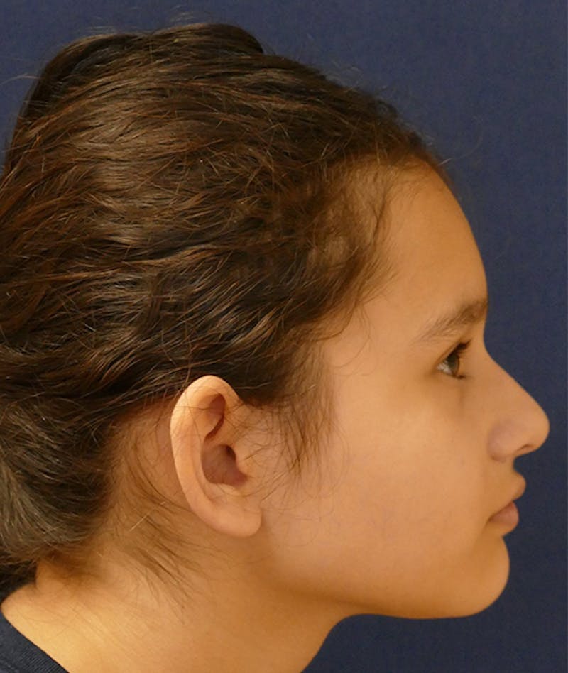 Otoplasty Before & After Gallery - Patient 423983 - Image 5