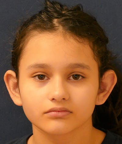 Otoplasty Before & After Gallery - Patient 423983 - Image 1