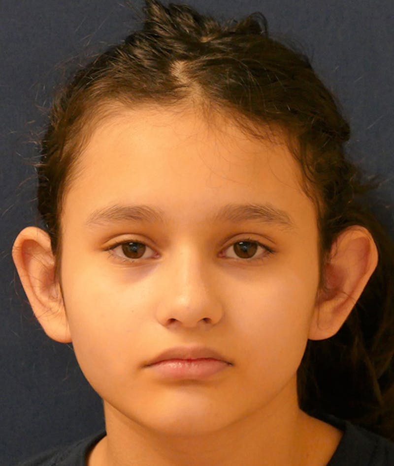 Otoplasty Before & After Gallery - Patient 423983 - Image 1