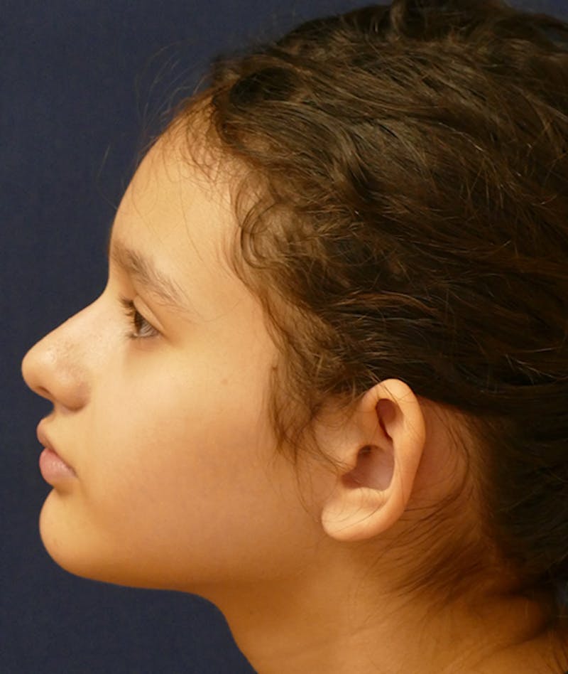 Otoplasty Before & After Gallery - Patient 423983 - Image 3