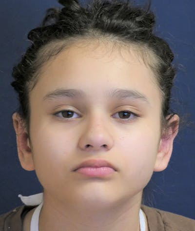 Otoplasty Before & After Gallery - Patient 423983 - Image 2