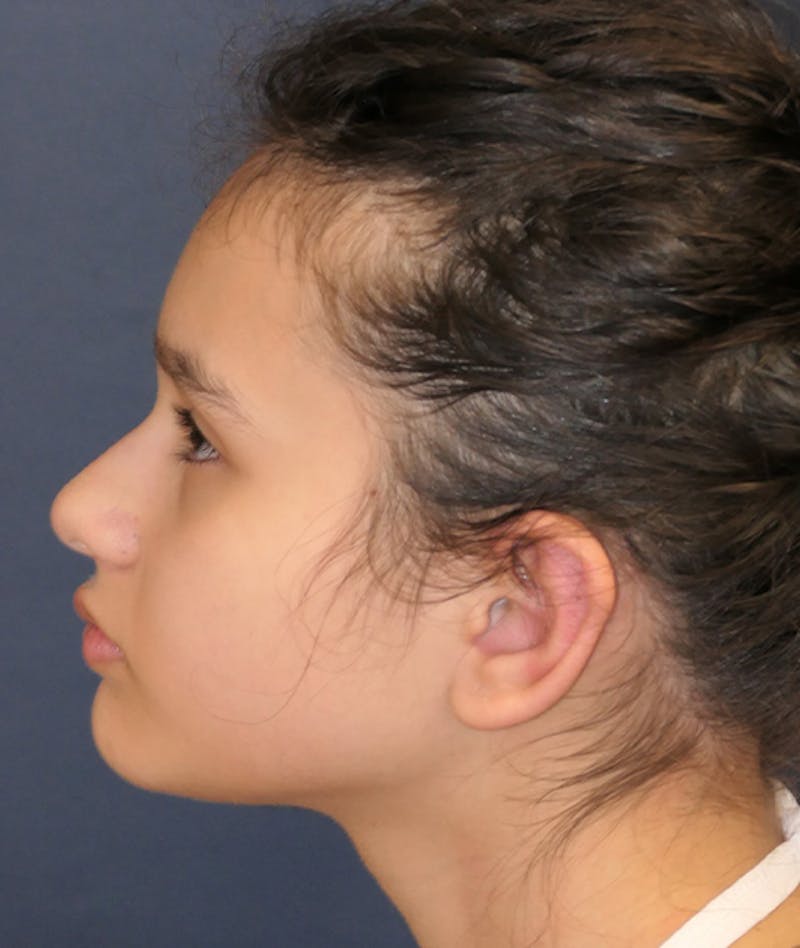Otoplasty Before & After Gallery - Patient 423983 - Image 4